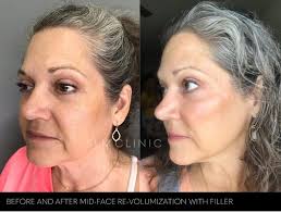 Face Slimming Procedures for Enhanced Contours