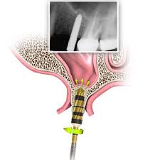 Image result for Maxillary Sinus
