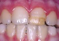 Enamel Defect Enamel Hypoplasia Dentist For Kids Brisbane Chermside And North Lakes Paediatric Dental Care