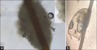 Piedra is the spanish word for stone. A Rare Case Of Coinfection With White Piedra And Pediculosis Capitis Vijay A Gupta S Rawat S Jain Sk Indian Dermatol Online J