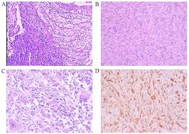 The histological appearance of the tumor was similar to that of the pleural biopsy. Multiple Intracranial Metastases From Postoperative Giant Sarcomatoid Malignant Pleural Mesothelioma A Case Report And Literature Review