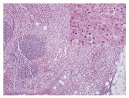 Although it is the most commonly diagnosed cancer in american women, breast cancer can impact people of all genders. Metastatic Malignant Mesothelioma To Lymph Node H E 10 The Inset Download Scientific Diagram