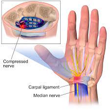 The median nerve can be injured at several sites in the arm, as can be. Median Nerve What Is It Symptoms Causes Prevention And Treatment Top Doctors