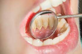 Learn about home teeth cleaning options and possible benefits in this free dental care video series from a dentist. Can You Remove Tartar At Home Dr Angela Berkovich Dmd