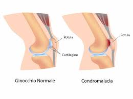 Dolore Ginocchio Anteriore Scopriamo Insieme Come Curarlo