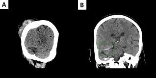 Image result for HSV Encephalitis