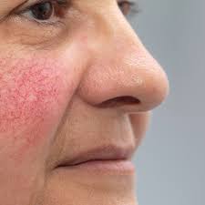 Rosacea, acne rosacea, acne erythematosa. Hautkrankheit Rosacea So Behandeln Sie Rote Flecken Im Gesicht Bildderfrau De