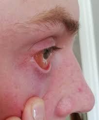 The White Part Of My Eye Sweled Today Because Of My Pollen Allergy Wtf