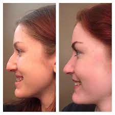 In these cases, customers do not have scarring, joints as well as scars after operations. Why We Need To Stop Shaming People Who Get Cosmetic Surgery