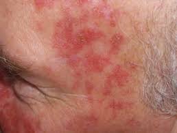 Cancerous tumors are characterized by cell division, which is no longer controlled as it is in normal tissue. Fluorouracil Cream Dermnet Nz