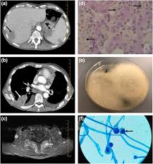 Mycobacteriosis, syphilis, histoplasmosis, mucormycosis, south american blastomycosis, anisakiasis, or anisakidosis (granulomatous gastritis) b. Disseminated Mucormycosis Due To Lichtheimia Corymbifera During Ibrutinib Treatment For Relapsed Chronic Lymphocytic Leukaemia A Case Report Clinical Microbiology And Infection