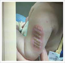 Bcg And Kawasaki Disease In Mexico And Japan Abstract Europe Pmc