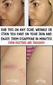 Rub This On Any Scar Wrinkle Or Stain You Have On Your Skin And Enjoy Them Disappear In Minutes Even Doctors Are Shocked Sagging Skin Remedies Skin Remedies Sagging Skin