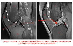 Bonjour, je crois que tu cherches l'introuvable, vu que les feux n'ont pas le même réglage temporisé, cela dépendant de la re : Docteur Bruno Levy Rupture Du Ligament Croise Anterieur