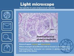 And environmental scanning electron microscopy, often called esem. Poststreptococcal Glomerulonephritis Psgn Flashcards Quizlet