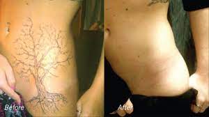 We are specialists when it comes to laser tattoo removal simply because that's all we do. The Profitable Economics Of The Tattoo Removal Industry