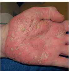 Pessoas com obesidade ou com suor excessivo podem apresentar casos mais graves deste tipo de psoríase. Psoriase O Que Voce Nao Pode Deixar De Saber Sobre Essa Doenca