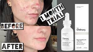 It can also reduce the appearance of any marks left over from blemishes on your skin, like red or brown dots. Testing The Ordinary Niacinamide And Zinc For My Acne Scarring For 1 Month Youtube