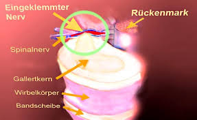Bei einer protrusion entsteht kein riss, sondern wölbt sich das material im gallertkern in einer richtung vor, was zur wölbung des faserringes führt und indirekt auf die neuralstrukturen drückt. Bandscheibenvorfall Op Behandlung Therapie Im Reha Zentrum