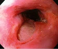 Causes of esophagitis include stomach acids backing up into the esophagus, infection, oral medications and allergies. Esophagitis Gastrointestinal Medbullets Step 2 3