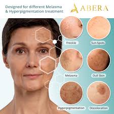 Image result for Melasma