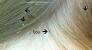 Nits Head Lice