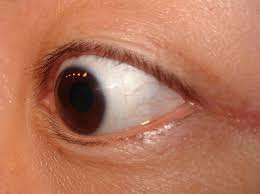 Harte kontaktlinsen werden heute nur noch selten benötigt. Kontaktlinse Wikipedia