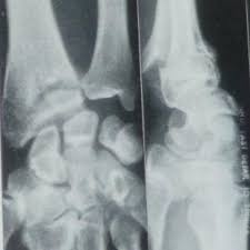 Poignet En Dos De Fourchette Fracture De Pouteau Colles Le Quotidien Du Medecin