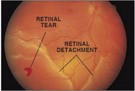 Depending on your condition, treatment goals may be to stop or slow the disease and preserve, improve or restore your vision. Retinal Detachment Treatment Services In Satellite Ahmedabad Netralok Retina Clinic Id 19256369097