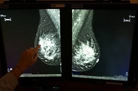 This image is a mammogram of a normal fatty breast, typical of older women, that does not have a lot of dense tissue. Breast Cancer Faq 8 Things You Should Know About Getting Your First Mammogram Daily Sabah