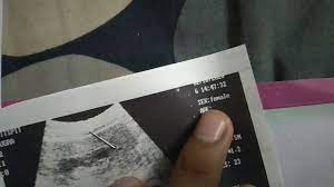 How To Know Baby Boy Or Girl In Ultrasound Report Part A Aqsa Mehmood Youtube