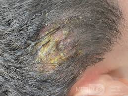 Image result for Tinea Capitis