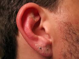 Apply saltwater on your ear piercing area. Infected Ear Piercing Causes And Treatments