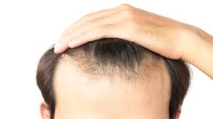 زراعة الشعر في الخبر تكلفة و افضل مراكز و اطباء زراعة الشعر تجميلي