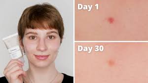 Azelaic acid comes as a gel, foam, and a cream to apply to the skin. The Ordinary Azelaic Acid Dark Spots Before And After 1 Month With Pictures Youtube
