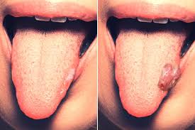 Image result for white cancer on tongue)