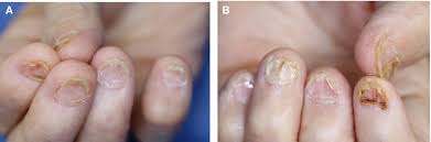 Image result for Koilonychia feet