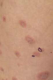 Image result for pruritic urticarial papules and plaques of pregnancy