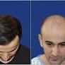 hair transplant in islamabad from drranairfan.com