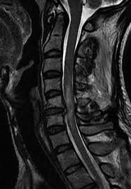 Hérnia discal aguda pós-traumática. Ressonância magnética – imagem... |  Download Scientific Diagram