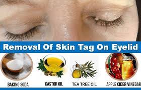 Pin By Emilio Rene On Best Methods Of Removing Skin Tag Skin Tag On Eyelid Tea Tree Oil Skin Tag Removal