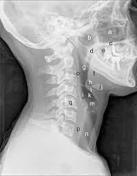 Foreign Bodies on Lateral Neck Radiographs in Adults: Imaging Findings and  Common Pitfalls 