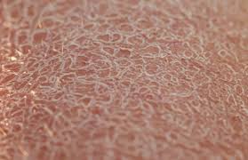 Image result for Dry Skin