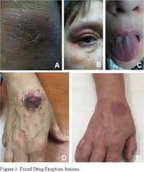 Image result for Fixed Drug Eruption