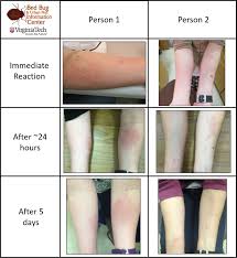 Image result for bedbug bites look like