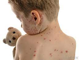 Put baking soda into a glass of water. How Do I Get Rid Of Chickenpox Scars With Pictures