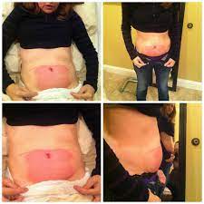 We did not find results for: Is Coolsculpting Worth It Does It Work Cost And Before And After Photos