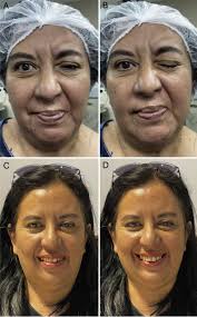 Hemifacial spasm associated with trigeminal neuralgia secondary to  trigeminal vascular compression