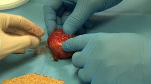 The earlier the detection of prostate cancer, the better the patient's chance of survival is. Southmead Hospital S Prostate Cancer Trial Aims To Save Sex Life Bbc News