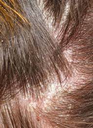 Understanding the causes and the knowing about the solutions is the first step towards improving and. Why Do I Have An Itchy Flaky Scalp